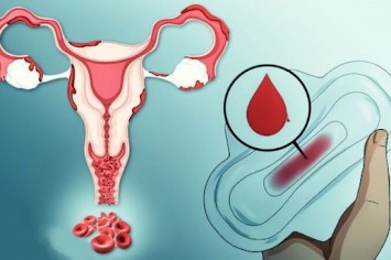 Коли цикл виходить з рівноваги: як лікують тяжкі менструальні кровотечі без органічної патології