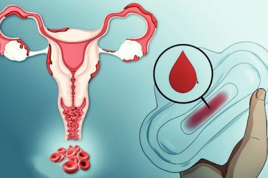 Коли цикл виходить з рівноваги: як лікують тяжкі менструальні кровотечі без органічної патології